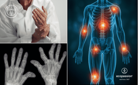 Rheumatoide Arthritis und medizinisches Cannabis – Mein neuer Anfang